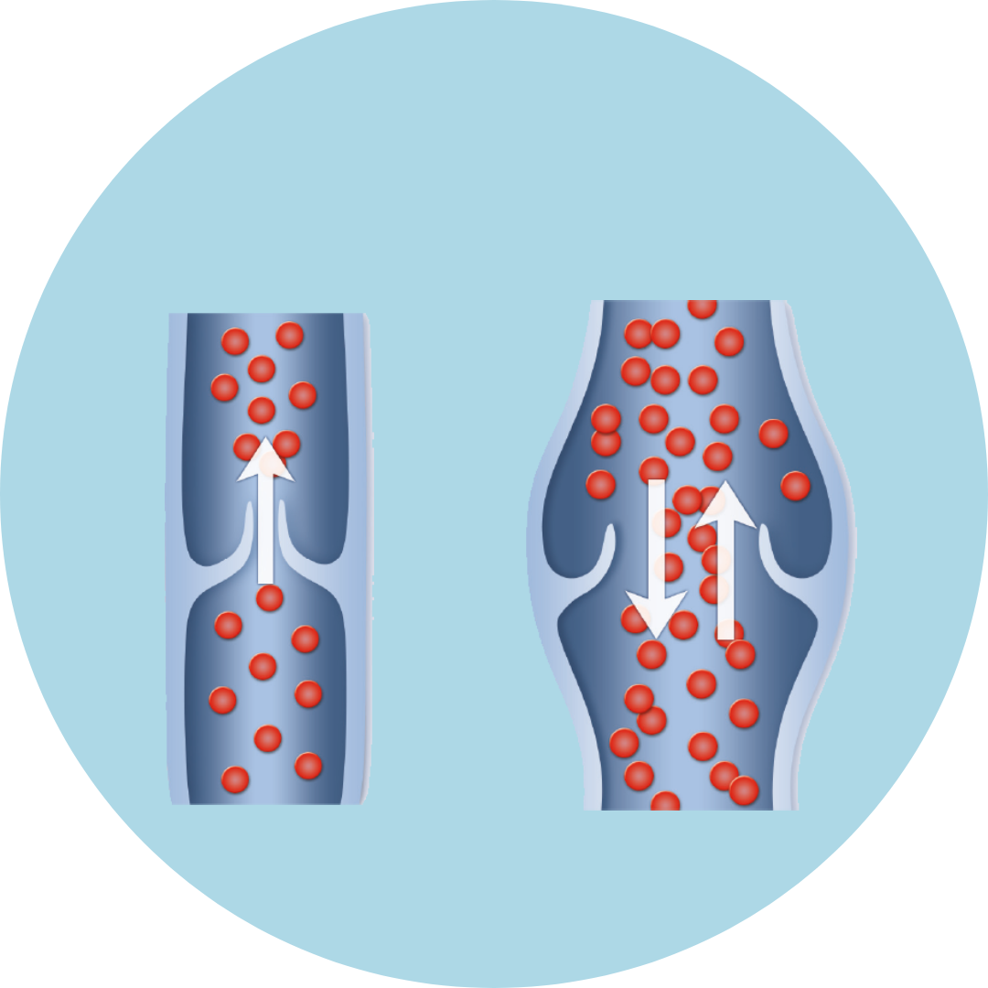 healthy vein 2 | win over varicose