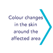 Colour changes in the skin around the affected area