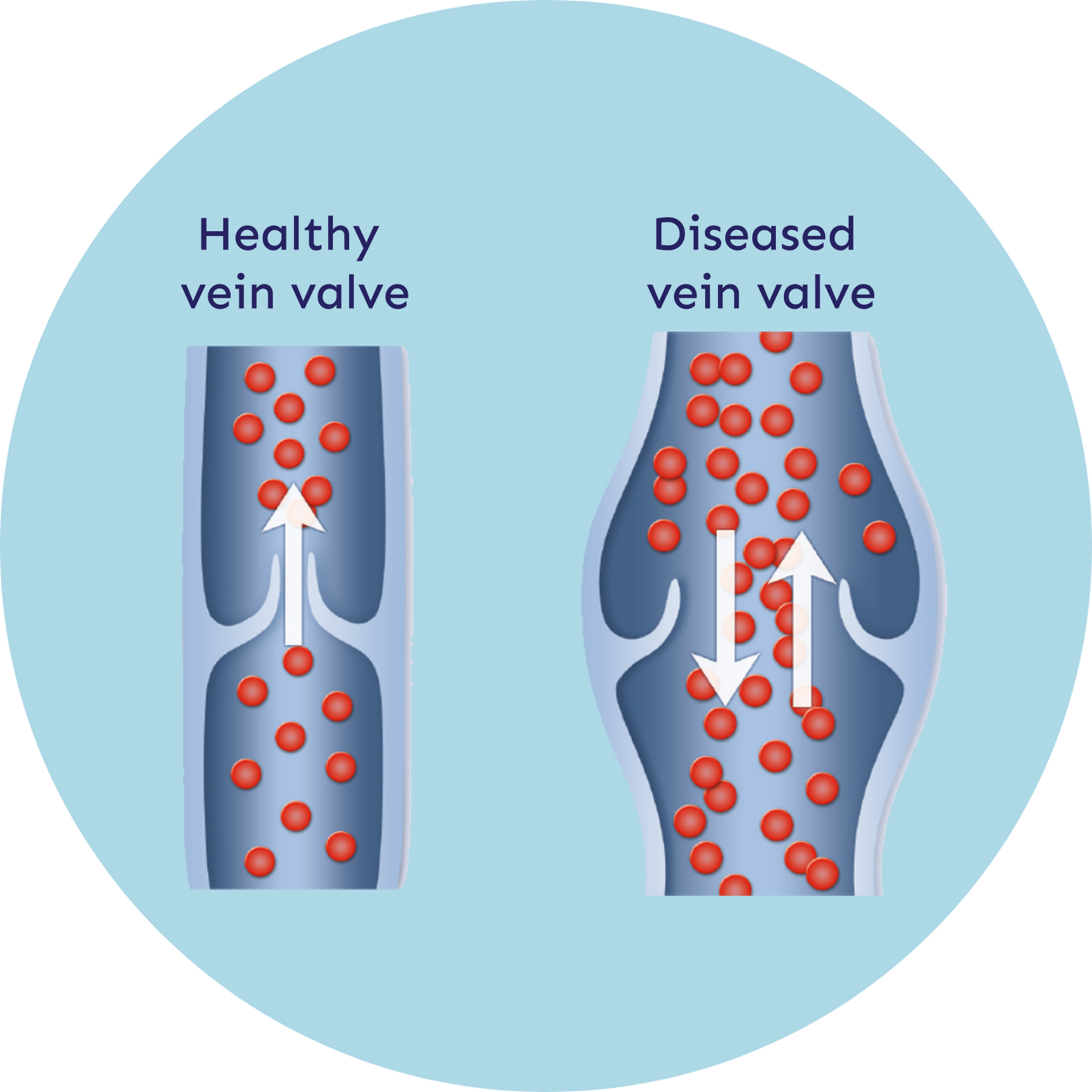 Healthy Veins Unhealthy Veins